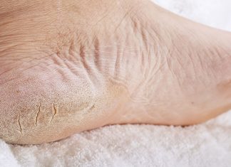 Molestas y dolorosas: ¡fisuras en los talones! Este remedio natural te da alivio inmediatamente